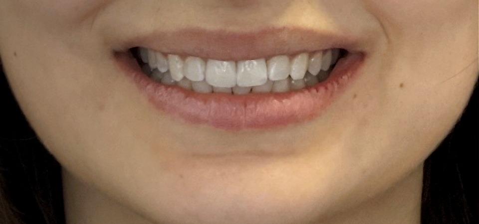 Patient efter osynlig tandreglering med Invisalign på tandläkare i Solna