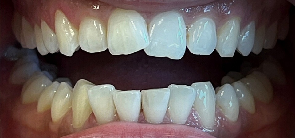 Närbild på tänder före Invisalign – synlig trångställning och felställning hos S&S Dental Solna