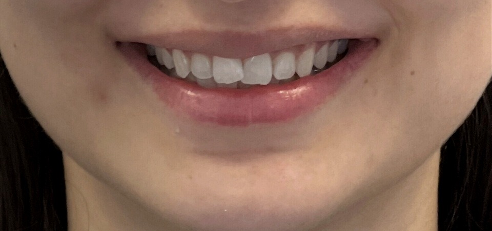 Före Tandreglering / Invisalign
