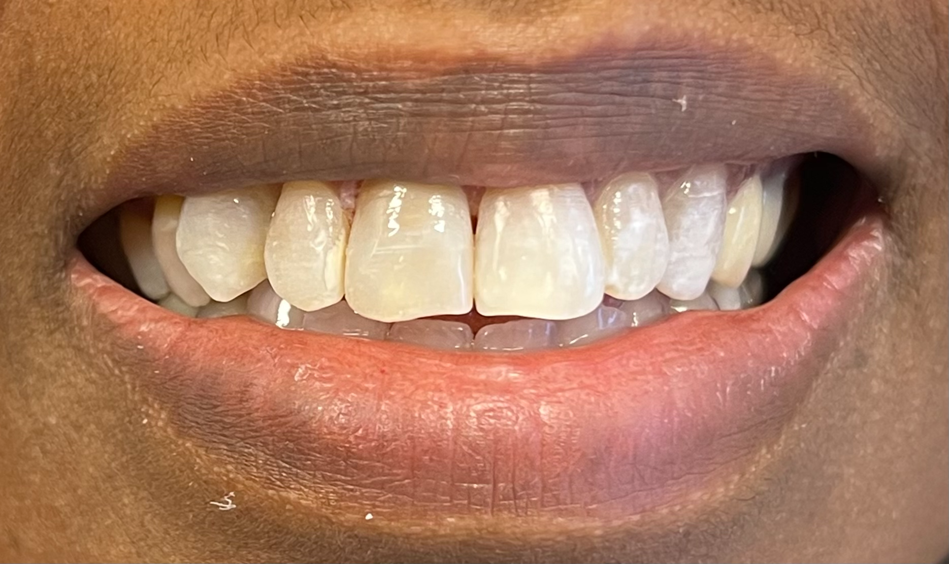 Naturligt utseende efter behandling med zirkoniumkrona hos S&S Dental i Solna