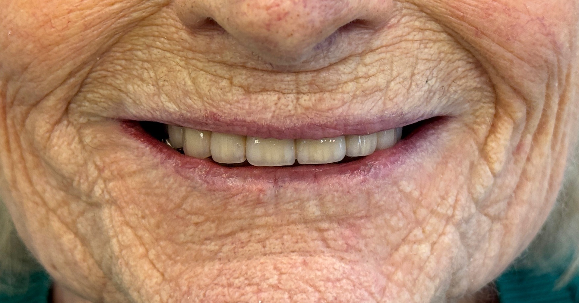 Resultat efter tandkrona i zirkonium hos S&S Dental Huvudsta Solna