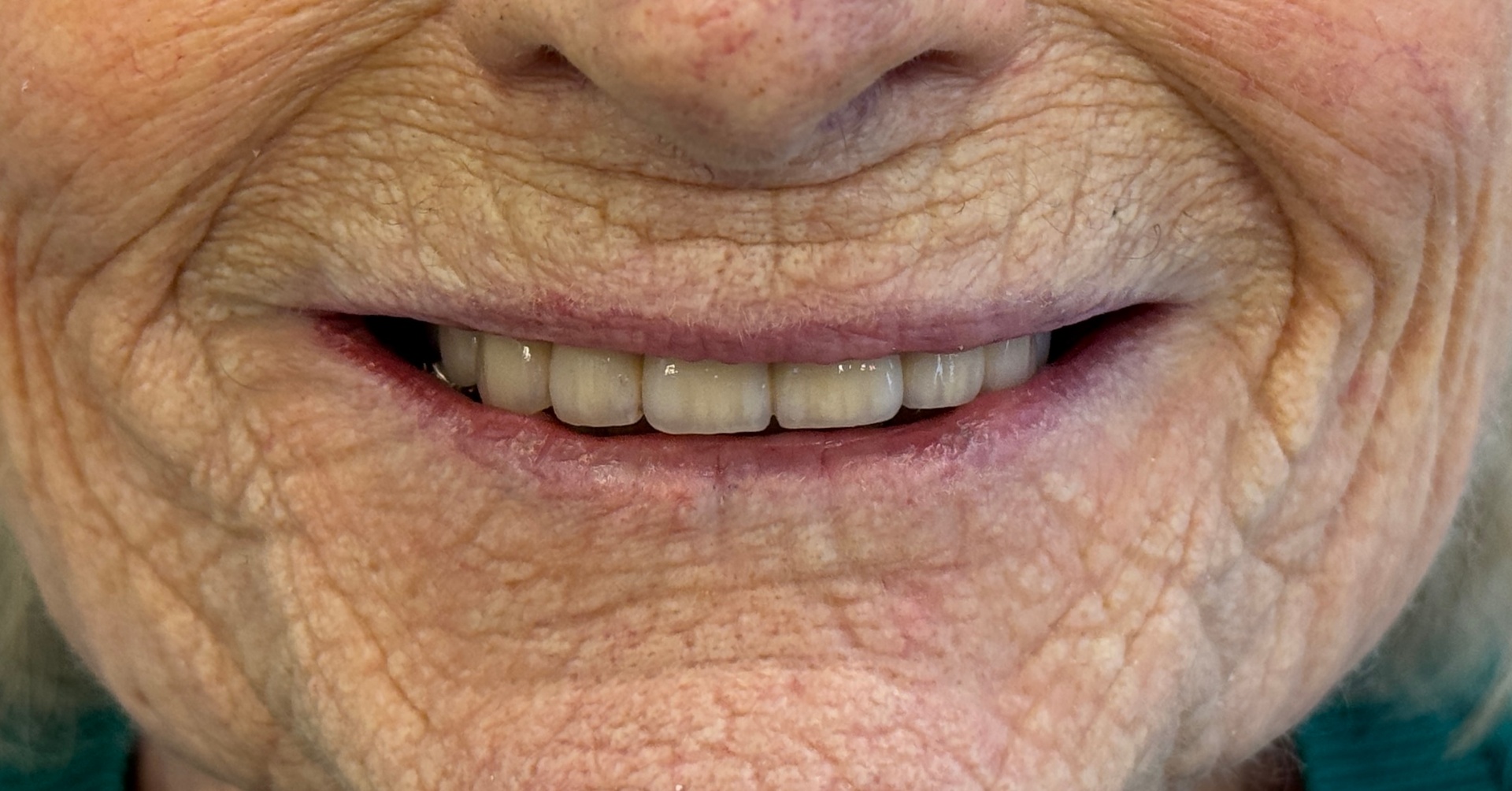 Resultat efter tandkrona i zirkonium hos S&S Dental Huvudsta Solna