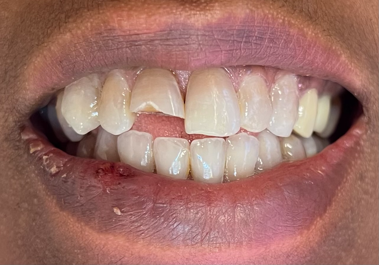 Tand med omfattande skada före behandling med tandkrona hos S&S Dental i Solna