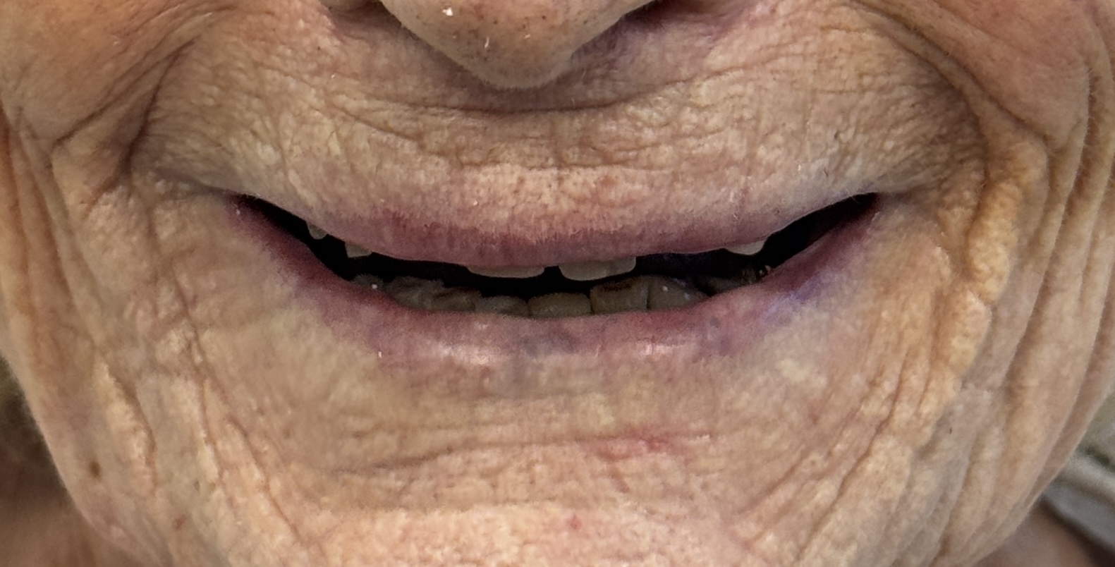 Patient innan tandkrona behandling hos S&S Dental Solna