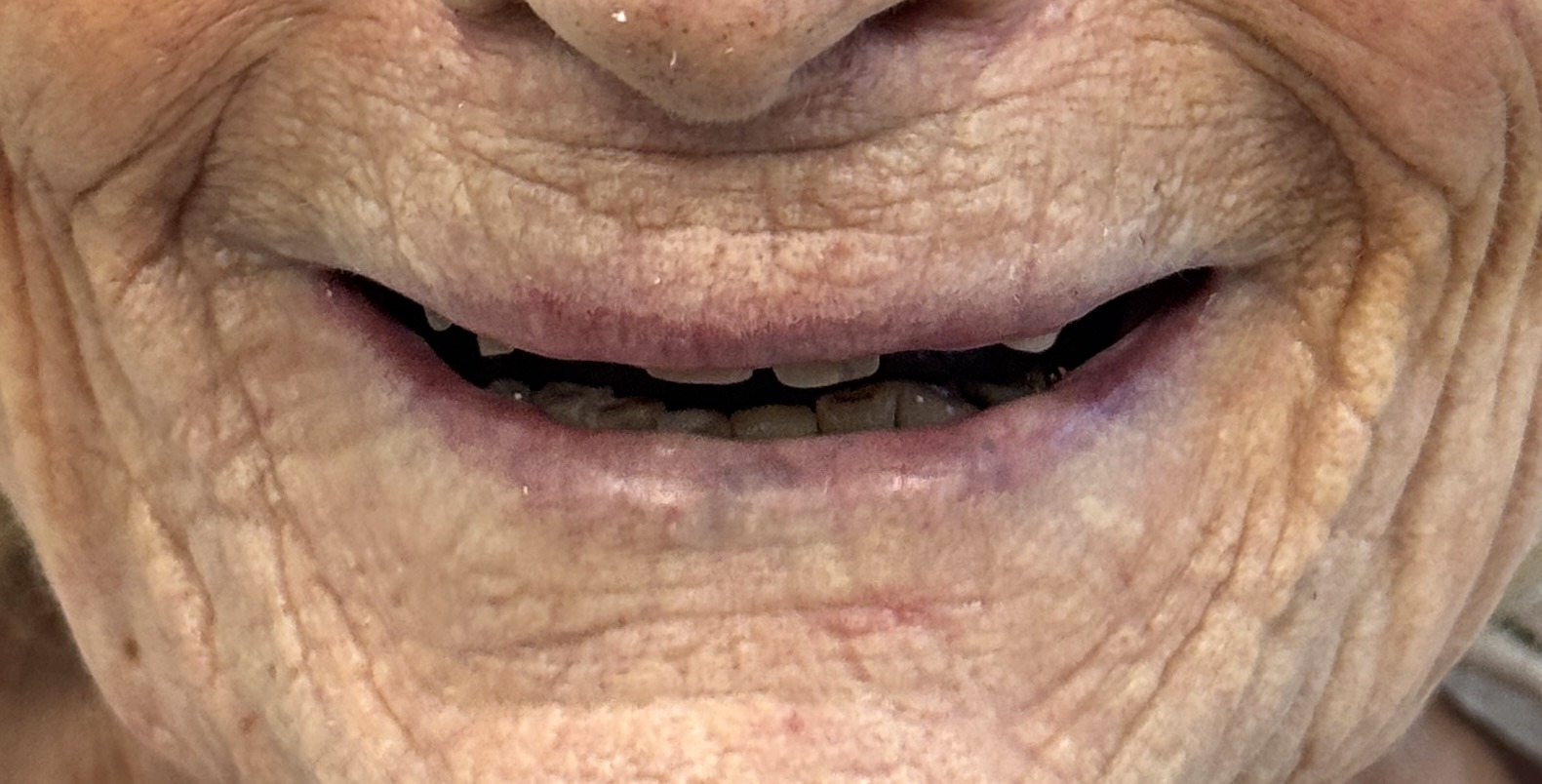 Patient innan tandkrona behandling hos S&S Dental Solna