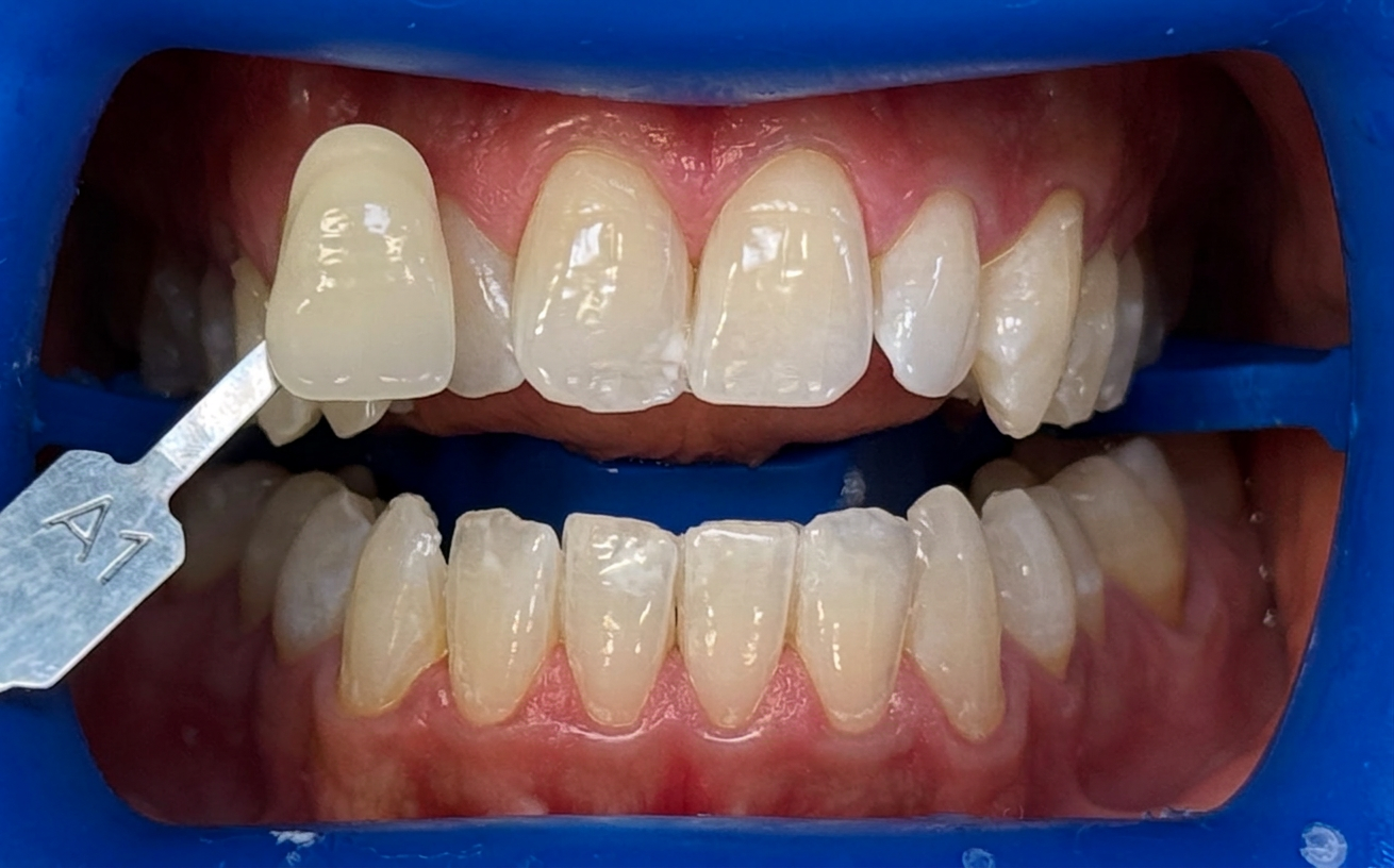 Tänder efter professionell tandblekning hos S&S Dental Solna – ljusare nyans A1