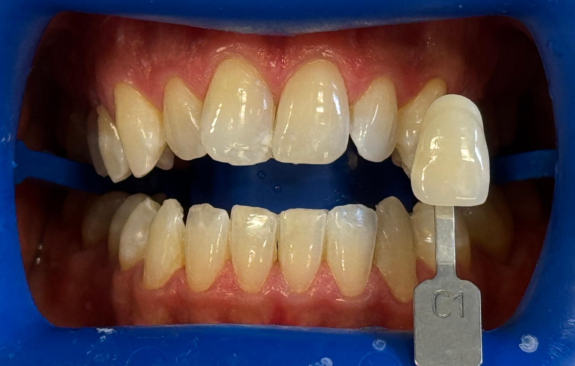 Tänder före professionell tandblekning hos S&S Dental Solna – färgnyans C1